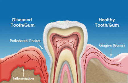 what is gum disease treatment